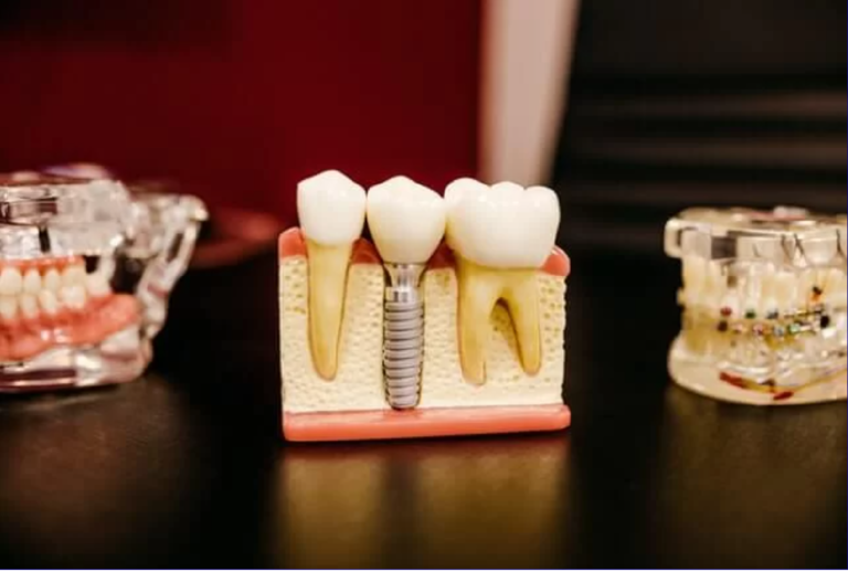 Implantul dentar – Ce este? Câte forme are? Cum îmi dau seama dacă am nevoie de o astfel de intervenție?